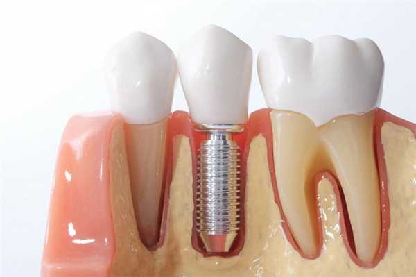 Можно ли провести имплантацию