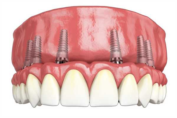 Варианты имплантации при воспалении тканей пародонта