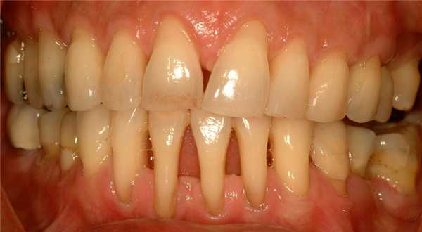 пример пародонтоза