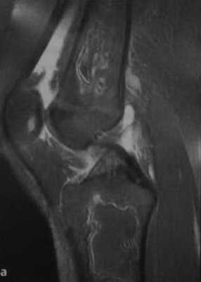 Снимки МРТ и КТ. Инфаркт кости