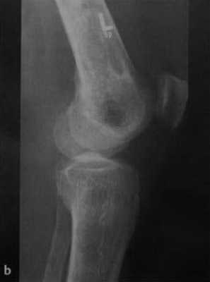 Снимки МРТ и КТ. Инфаркт кости