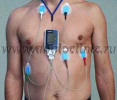 Холтеровское мониторирование ЭКГ