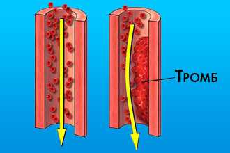 Образование тромба