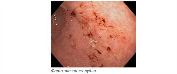 Фото эрозии желудка