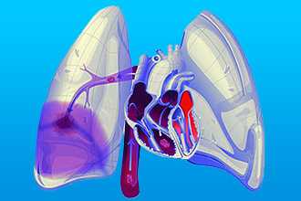 Тромбоэмболия легочной артерии