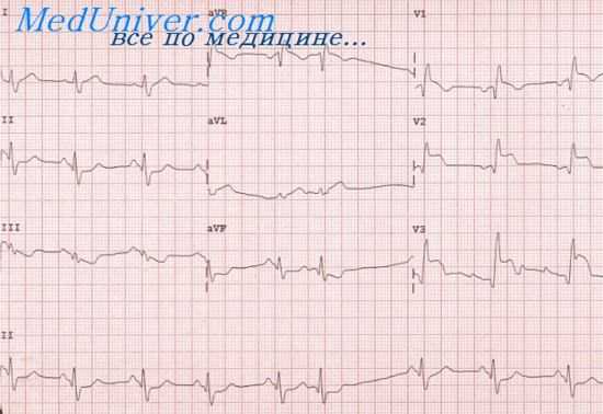 инфаркт задней стенки левого желудочка