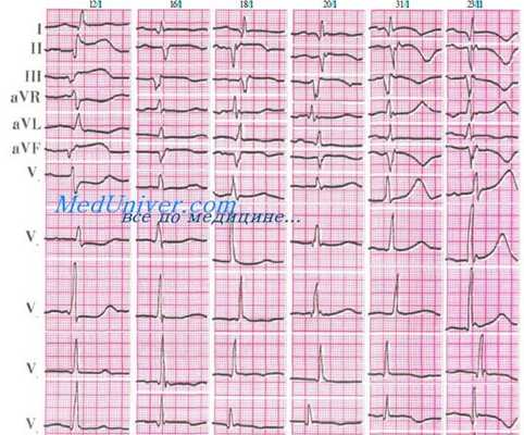 инфаркт левого жеулдочка