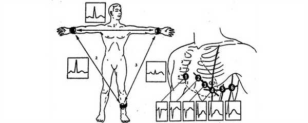 Точки наложения электродов при снятии электрокардиограммы