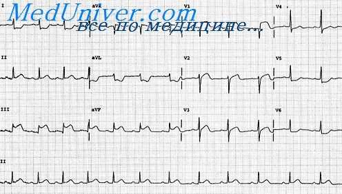 инфаркт миокарда