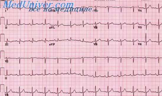 инфаркт миокарда