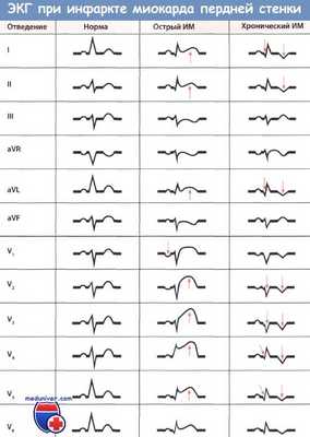 Изменения ЭКГ при инфаркте миокарда передней стенки левого желудочка