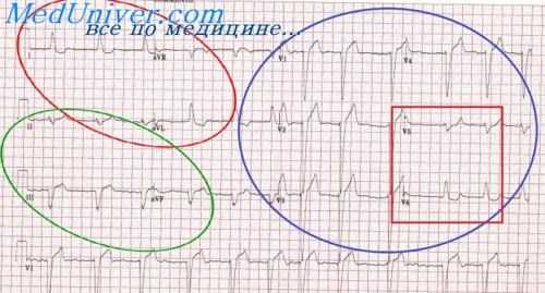 экг при инфаркте миокарда