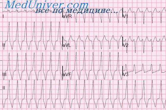 изменения экг