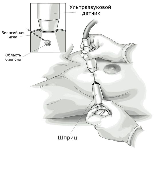 Пункция молочной железы