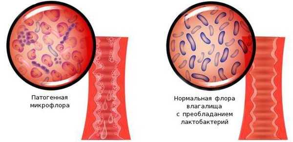Патогенная микрофлора влагалища