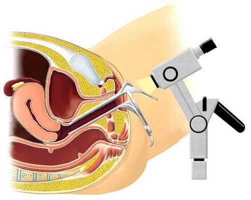 Вагиноскопия