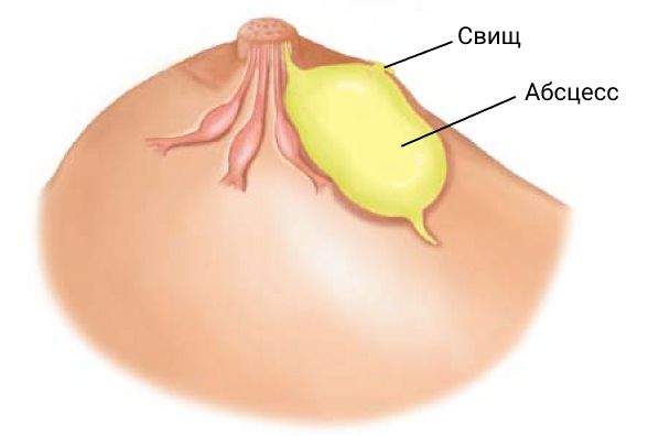 Свищ молочной железы