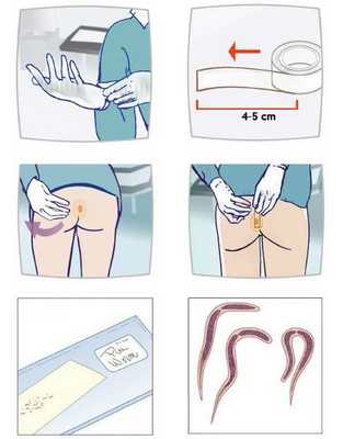 Перианальный соскоб на энтеробиоз