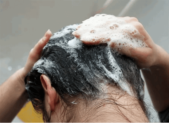 выпадение волос при себорее