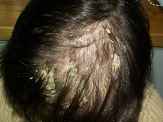 Асбестовидный лишай