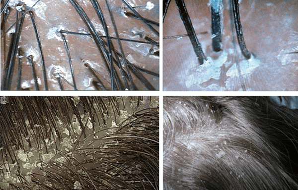 выпадение волос при себорее