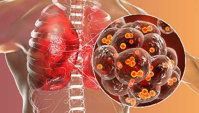 Стафилококковый эндокардит — воспаление внутренней оболочки сердца