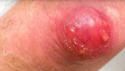 Карбункул — конгломерат фурункулов, объединённых общим инфильтратом