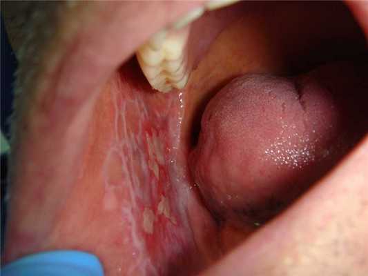 Красный плоский лишай