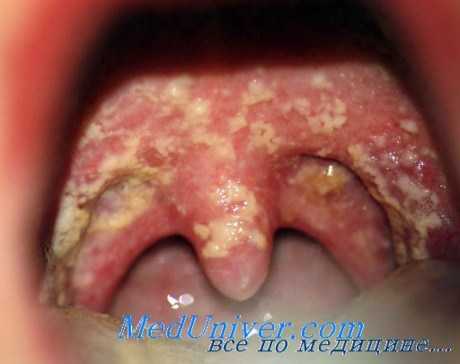 Кандидоз полости рта