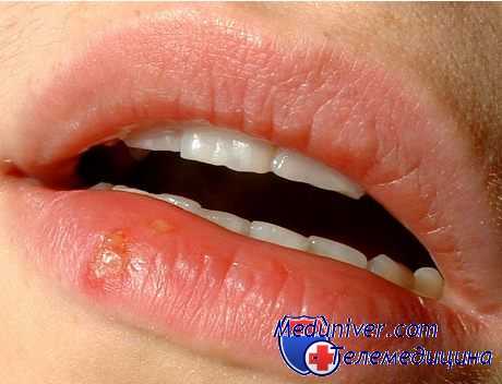 Герпес на губе