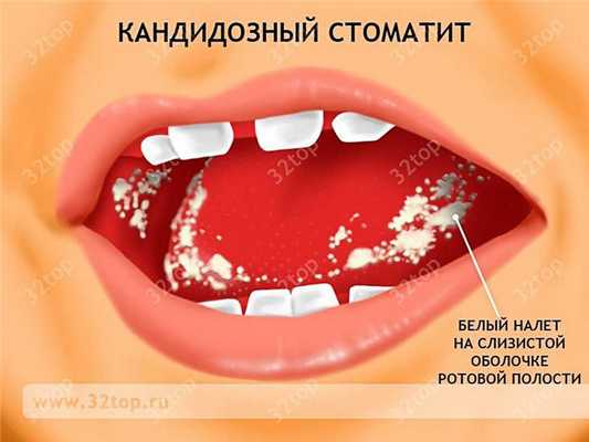 Кандидозный стоматит