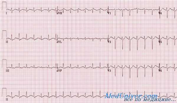 ЭКГ при миокардите