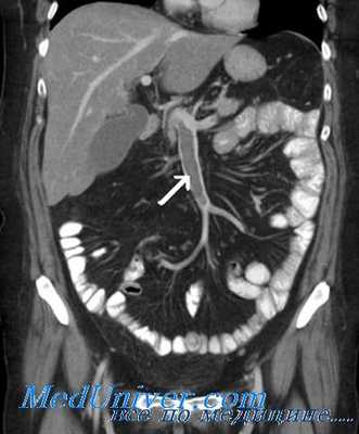Ангиография при мезентриальном тромбозе