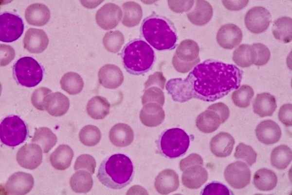 Хронический лейкоз