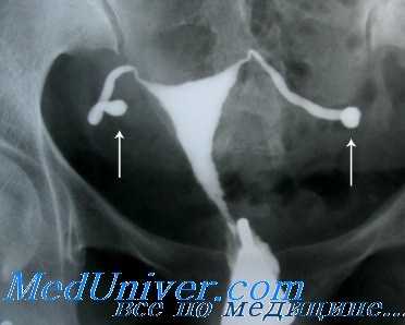 инфекционные причины бесплодия