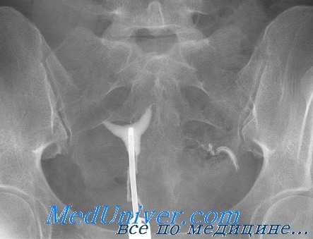 инфекционные причины бесплодия