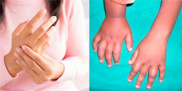 Инфекционный токсико-аллергический артрит