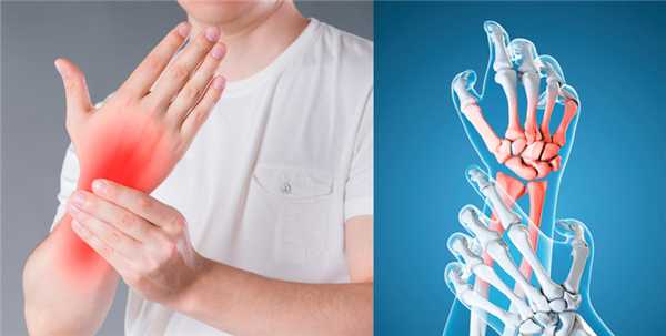 Симптомы острого артрита