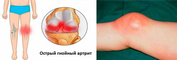Острый гнойный артрит