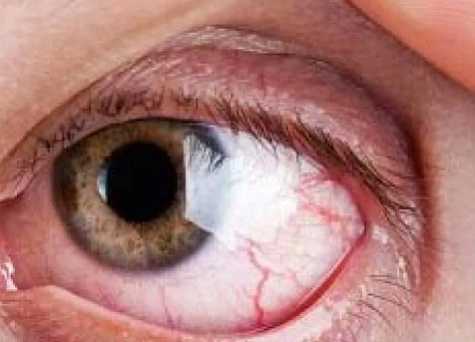 Герпетический кератит