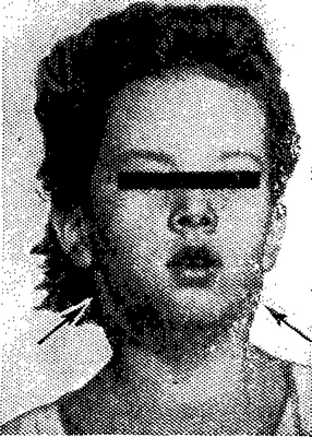 Больная инфекционным мононуклеозом: характерное увеличение шейных лимфатических узлов, изменение конфигурации шеи (указано стрелками).