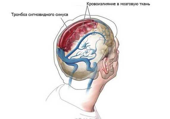 Наружный отит