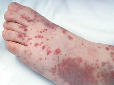 Тромбоцитопеническая пурпура