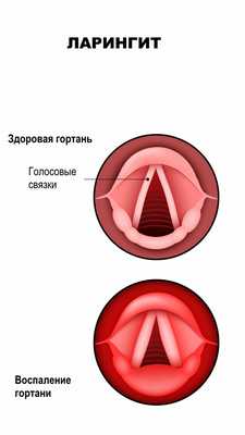Ларингит.jpg