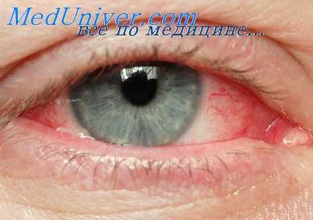 карбоангидраза при глаукоме