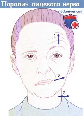 Полный паралич лицевого нерва