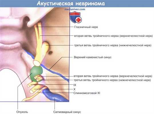 Акустическая невринома мостомозжечкового угла