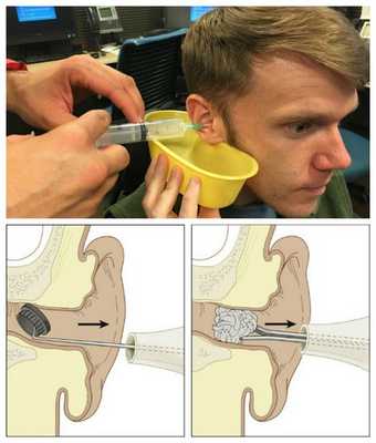 Консервативные способы извлечения инородного тела из уха