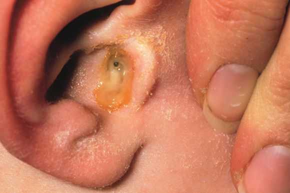 Признак среднего отита при перфорации барабанной перепонки