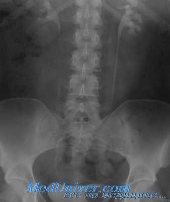 Урография при уретроцеле